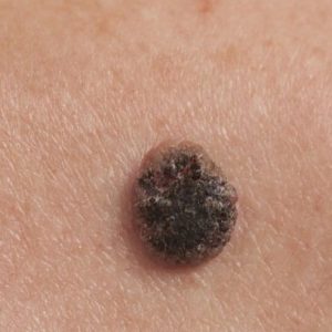 _92607945_melanoma