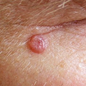 Basal cell carcinoma