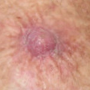 Squamous_Cell_Carcinoma_Left_Ventral_Forearm
