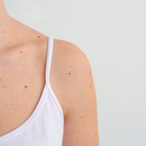 Young woman with moles on light background